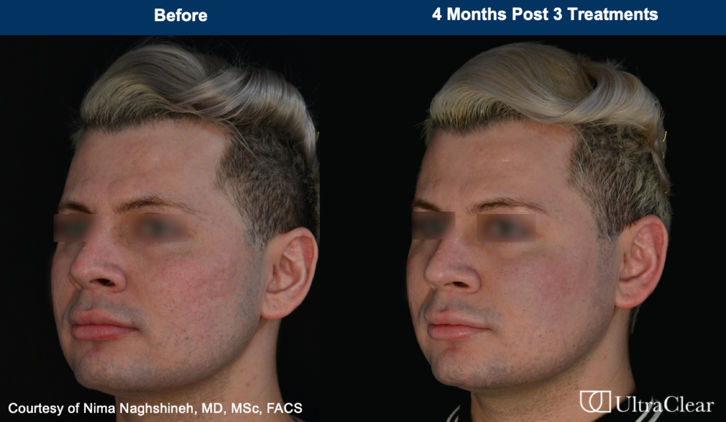 UltraClear laser treatment before and after
