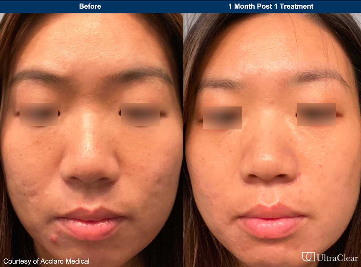 UltraClear laser treatment before and after