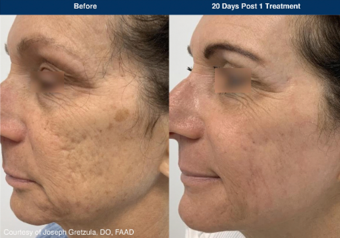 UltraClear laser treatment before and after