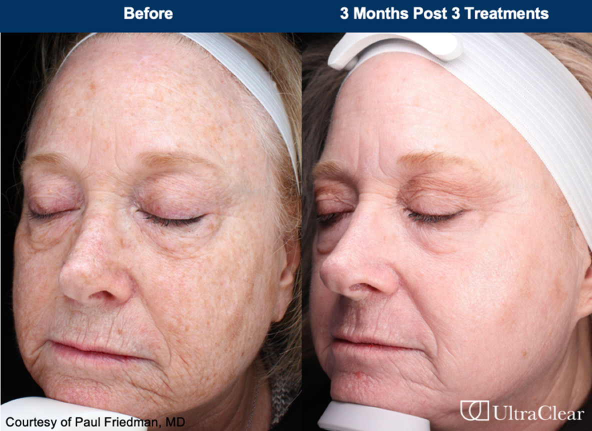 UltraClear laser treatment before and after