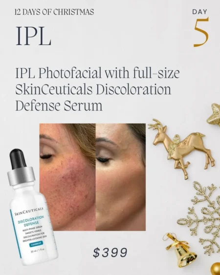 Day - 5: IPL Photofacial